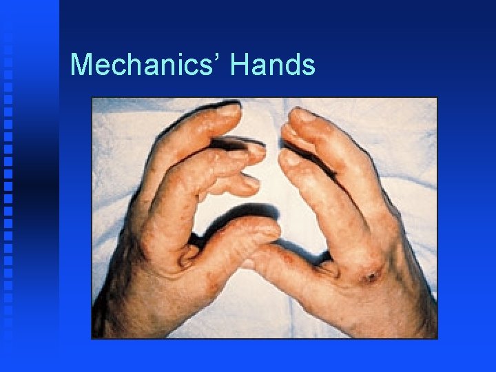 Mechanics’ Hands 