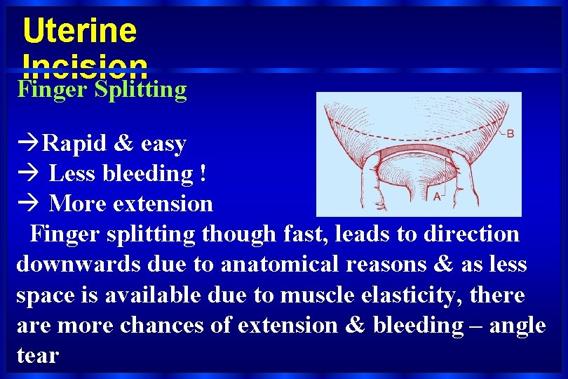Uterine Incision Finger Splitting àRapid & easy à Less bleeding ! à More extension