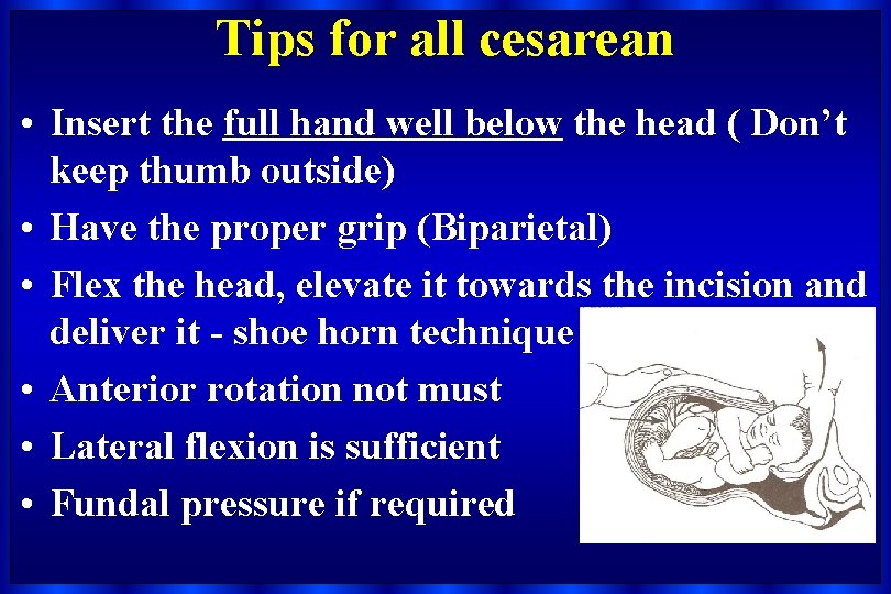 Tips for all cesarean • Insert the full hand well below the head (