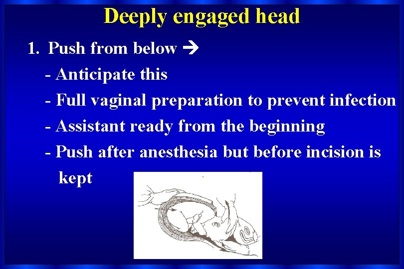 Deeply engaged head 1. Push from below - Anticipate this - Full vaginal preparation