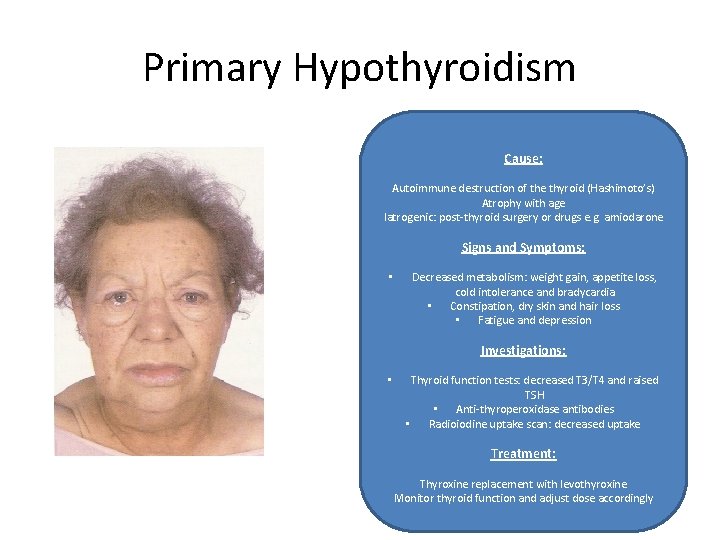 Primary Hypothyroidism Cause: Autoimmune destruction of the thyroid (Hashimoto’s) Atrophy with age Iatrogenic: post-thyroid