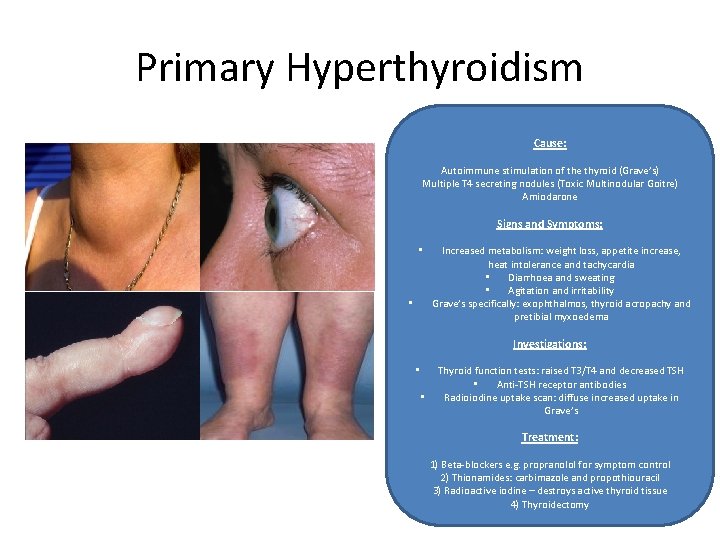 Primary Hyperthyroidism Cause: Autoimmune stimulation of the thyroid (Grave’s) Multiple T 4 secreting nodules
