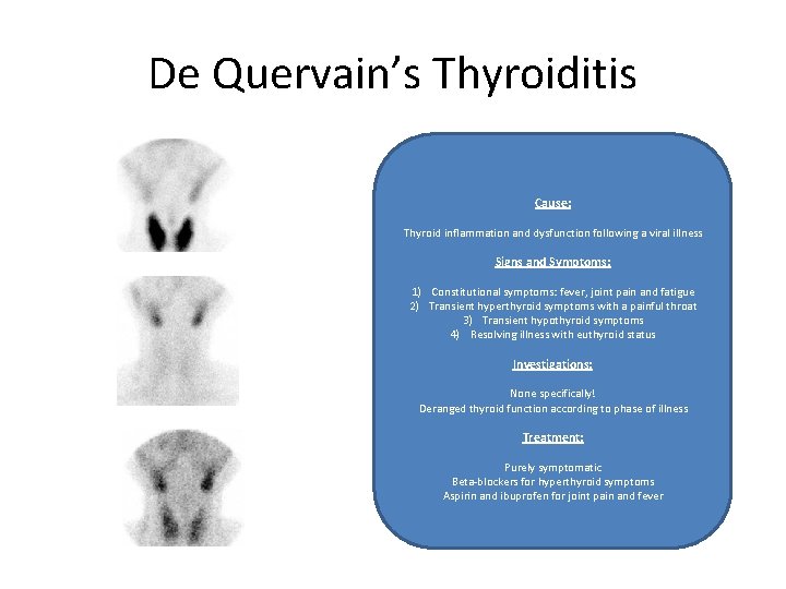 De Quervain’s Thyroiditis Cause: Thyroid inflammation and dysfunction following a viral illness Signs and