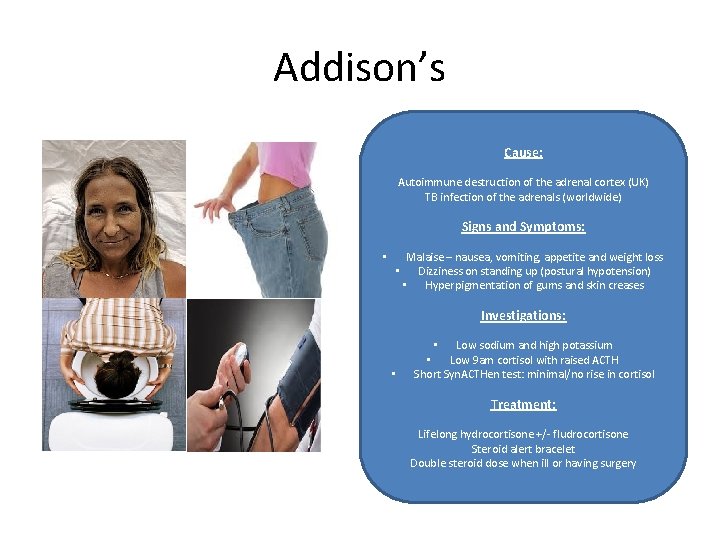 Addison’s Cause: Autoimmune destruction of the adrenal cortex (UK) TB infection of the adrenals