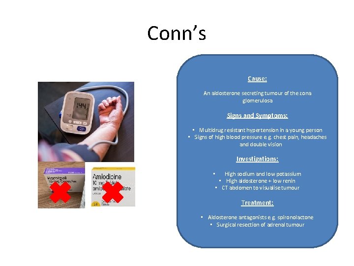 Conn’s Cause: An aldosterone secreting tumour of the zona glomerulosa Signs and Symptoms: •
