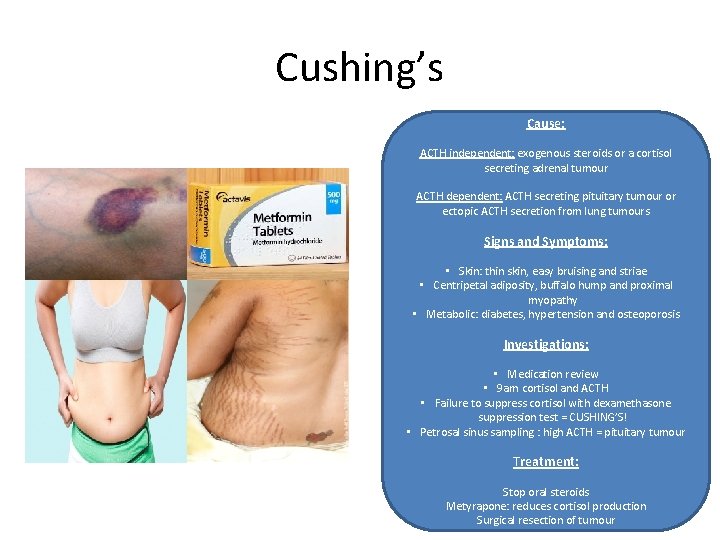 Cushing’s Cause: ACTH independent: exogenous steroids or a cortisol secreting adrenal tumour ACTH dependent: