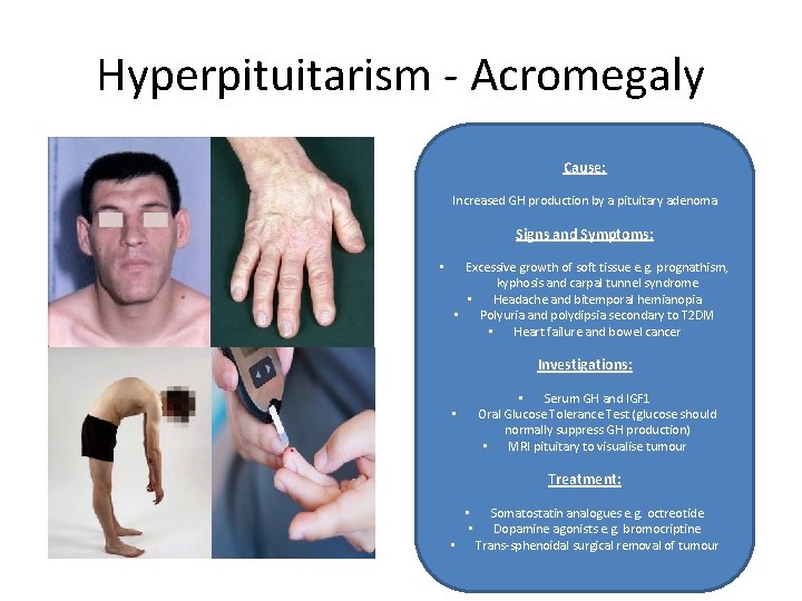 Hyperpituitarism - Acromegaly Cause: Increased GH production by a pituitary adenoma Signs and Symptoms: