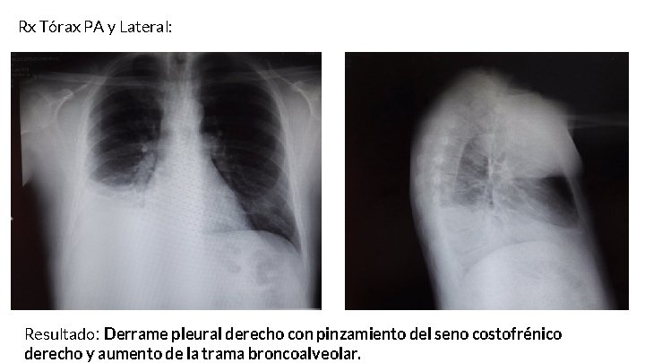 Rx Tórax PA y Lateral: Resultado: Derrame pleural derecho con pinzamiento del seno costofrénico