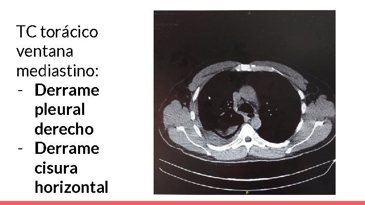 TC torácico ventana mediastino: - Derrame pleural derecho - Derrame cisura horizontal 