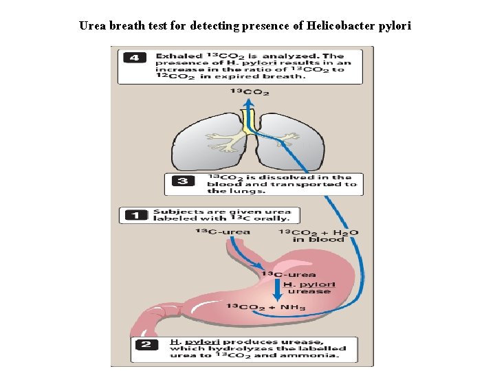 Urea breath test for detecting presence of Helicobacter pylori 