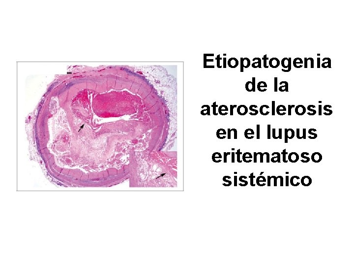 Etiopatogenia de la aterosclerosis en el lupus eritematoso sistémico 