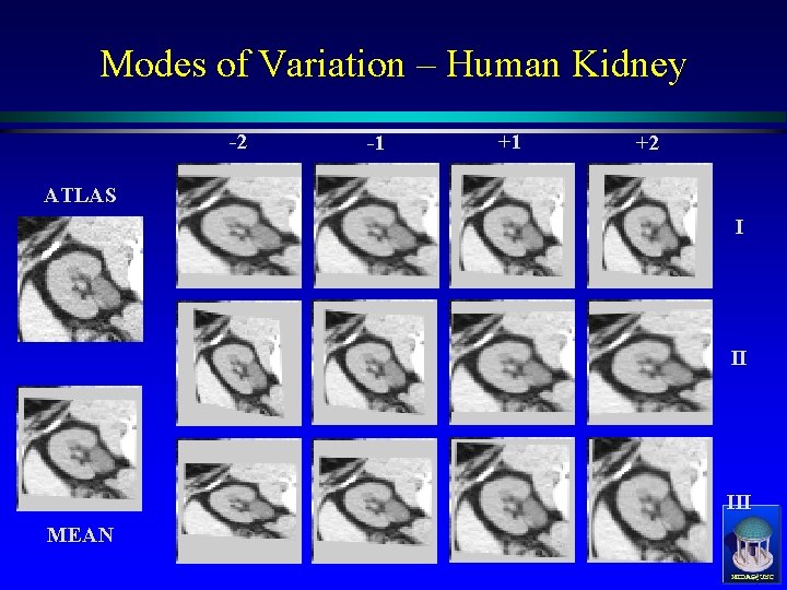 Modes of Variation – Human Kidney -2 -1 +1 +2 ATLAS I II III