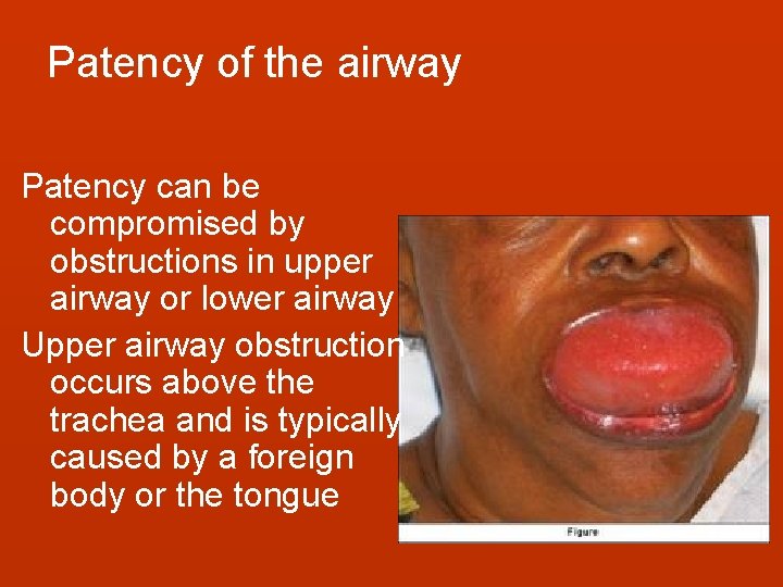 Patency of the airway Patency can be compromised by obstructions in upper airway or