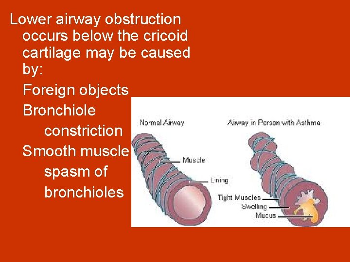Lower airway obstruction occurs below the cricoid cartilage may be caused by: Foreign objects