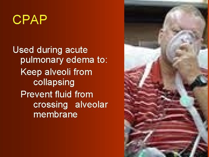 CPAP Used during acute pulmonary edema to: Keep alveoli from collapsing Prevent fluid from