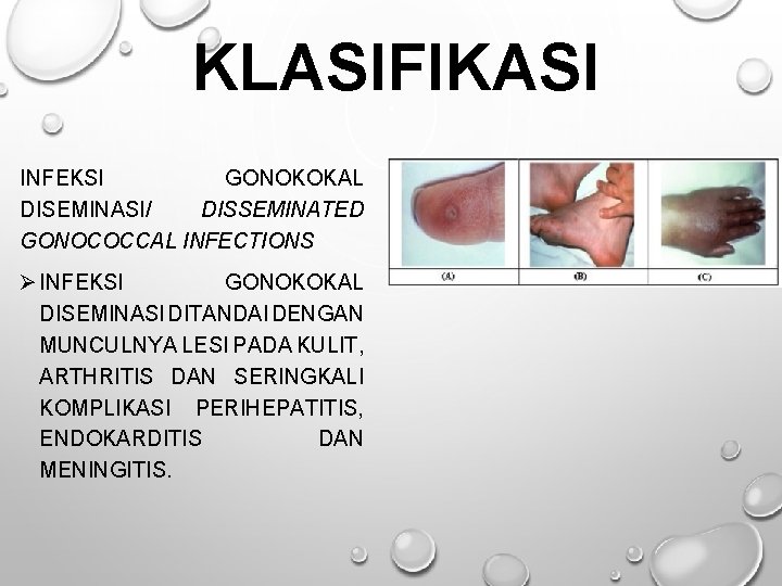 KLASIFIKASI INFEKSI GONOKOKAL DISEMINASI/ DISSEMINATED GONOCOCCAL INFECTIONS Ø INFEKSI GONOKOKAL DISEMINASI DITANDAI DENGAN MUNCULNYA KLASIFIKASI INFEKSI GONOKOKAL DISEMINASI/ DISSEMINATED GONOCOCCAL INFECTIONS Ø INFEKSI GONOKOKAL DISEMINASI DITANDAI DENGAN MUNCULNYA