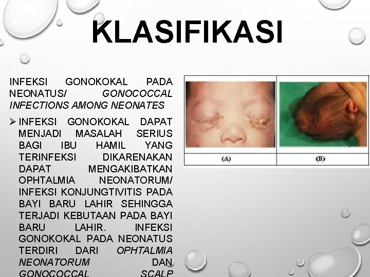 KLASIFIKASI INFEKSI GONOKOKAL PADA NEONATUS/ GONOCOCCAL INFECTIONS AMONG NEONATES Ø INFEKSI GONOKOKAL DAPAT MENJADI