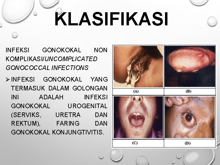 KLASIFIKASI INFEKSI GONOKOKAL NON KOMPLIKASI/UNCOMPLICATED GONOCOCCAL INFECTIONS Ø INFEKSI GONOKOKAL YANG TERMASUK DALAM GOLONGAN