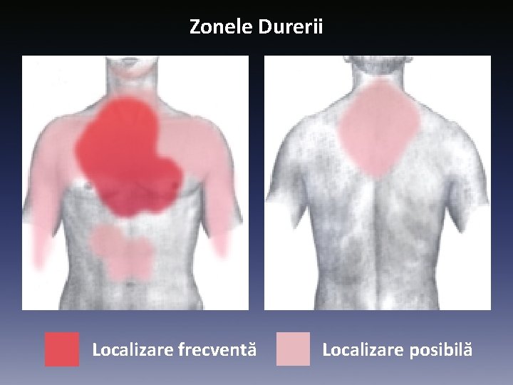 Zonele Durerii Localizare frecventă Localizare posibilă 