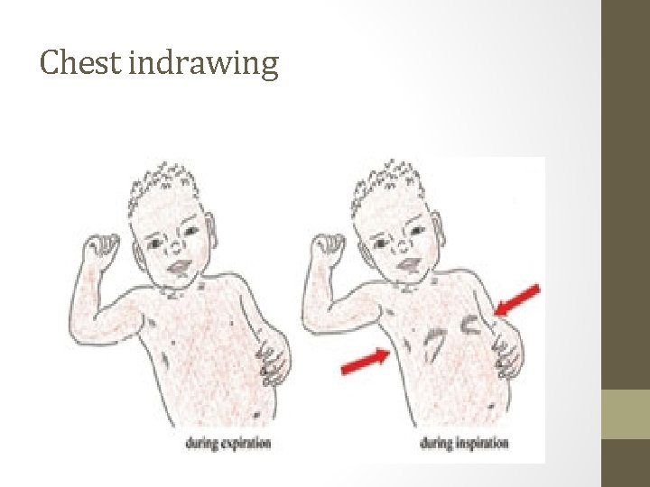 Chest indrawing 