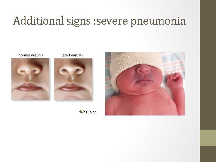 Additional signs : severe pneumonia 