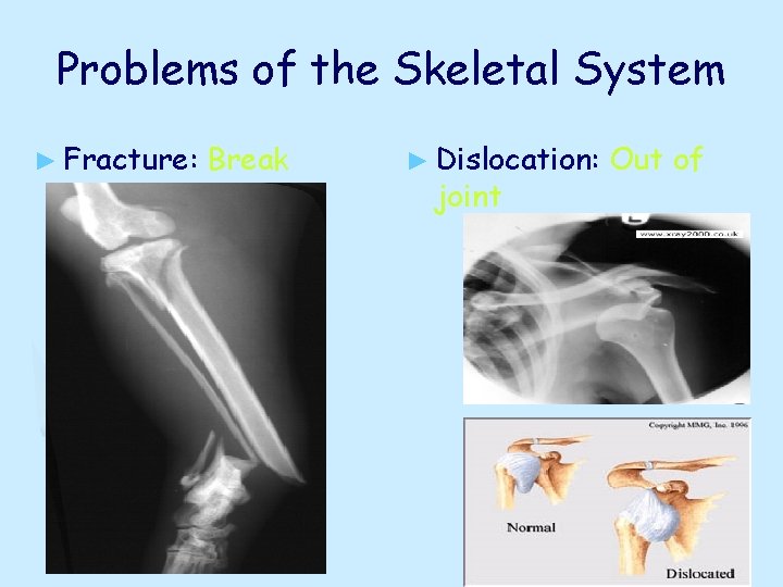 Problems of the Skeletal System ► Fracture: Break ► Dislocation: joint Out of 