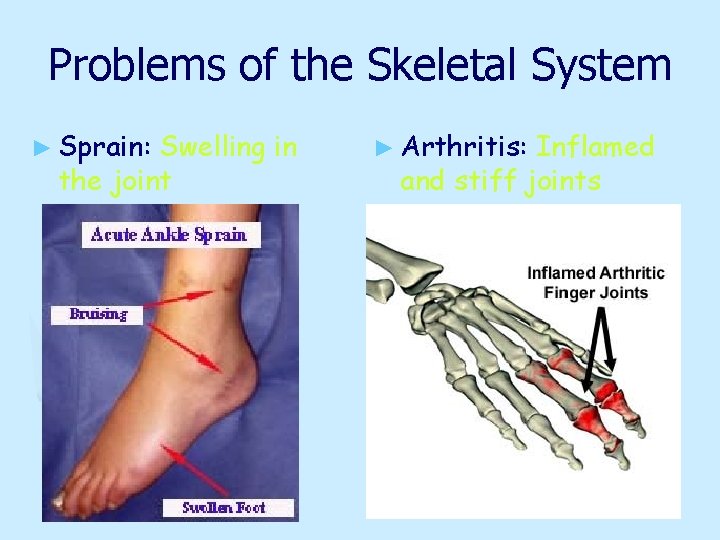 Problems of the Skeletal System ► Sprain: Swelling in the joint ► Arthritis: Inflamed