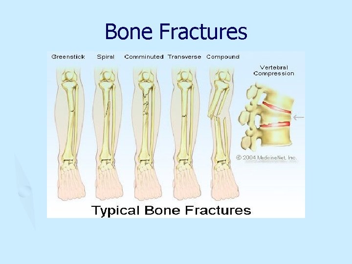 Bone Fractures 