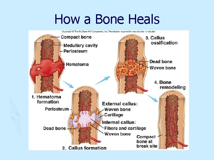 How a Bone Heals 