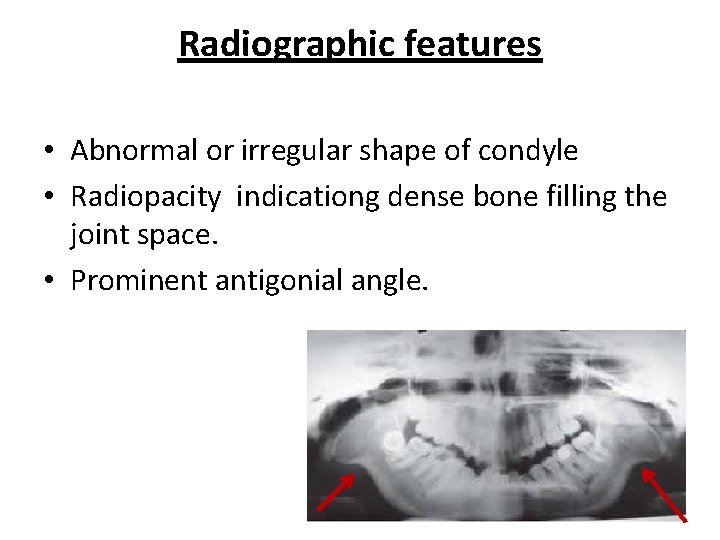 Radiographic features • Abnormal or irregular shape of condyle • Radiopacity indicationg dense bone