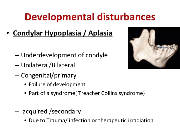 Developmental disturbances • Condylar Hypoplasia / Aplasia – Underdevelopment of condyle – Unilateral/Bilateral –
