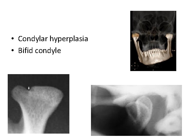 • Condylar hyperplasia • Bifid condyle 