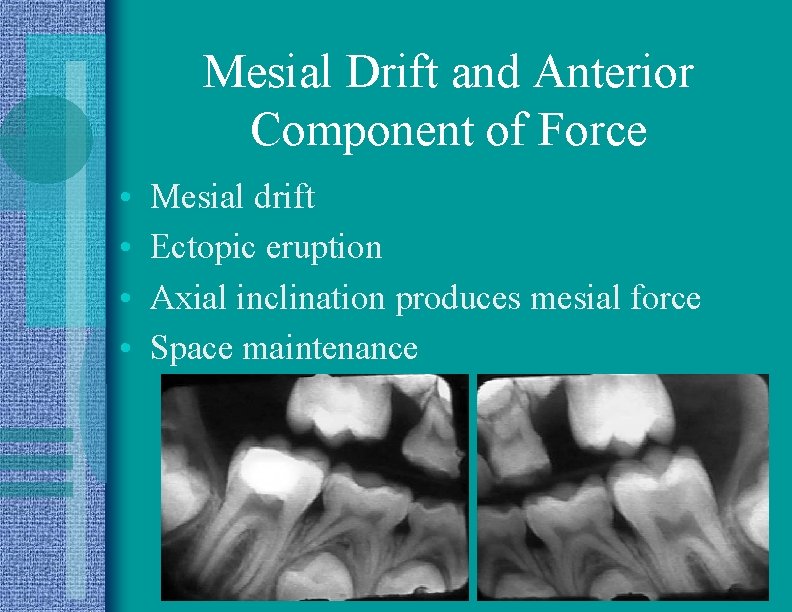 Mesial Drift and Anterior Component of Force • • Mesial drift Ectopic eruption Axial