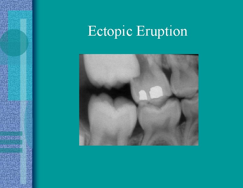 Ectopic Eruption 