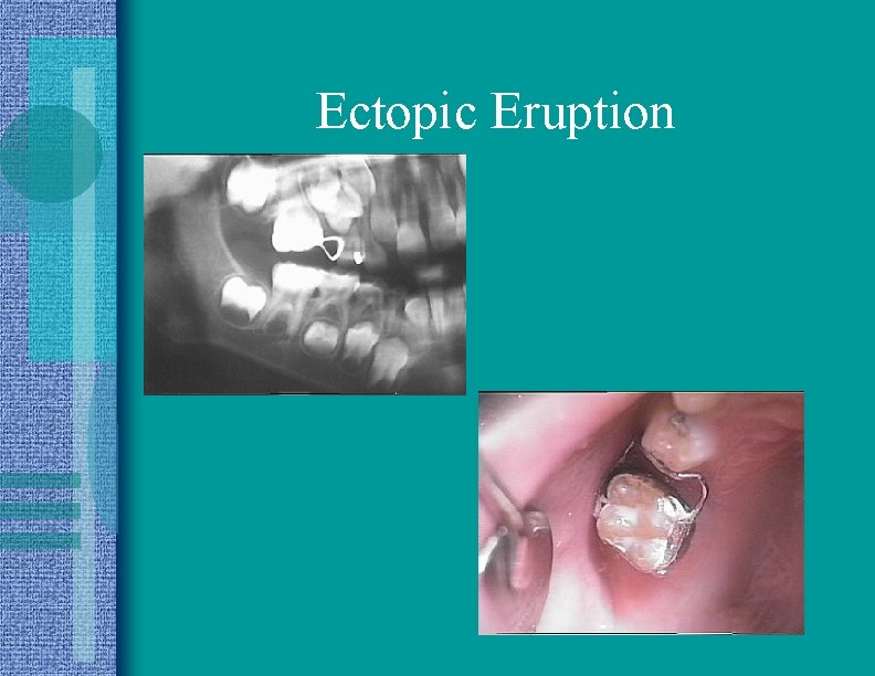 Ectopic Eruption 