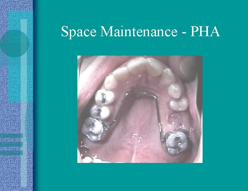 Space Maintenance - PHA 