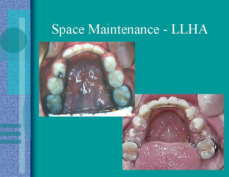 Space Maintenance - LLHA 