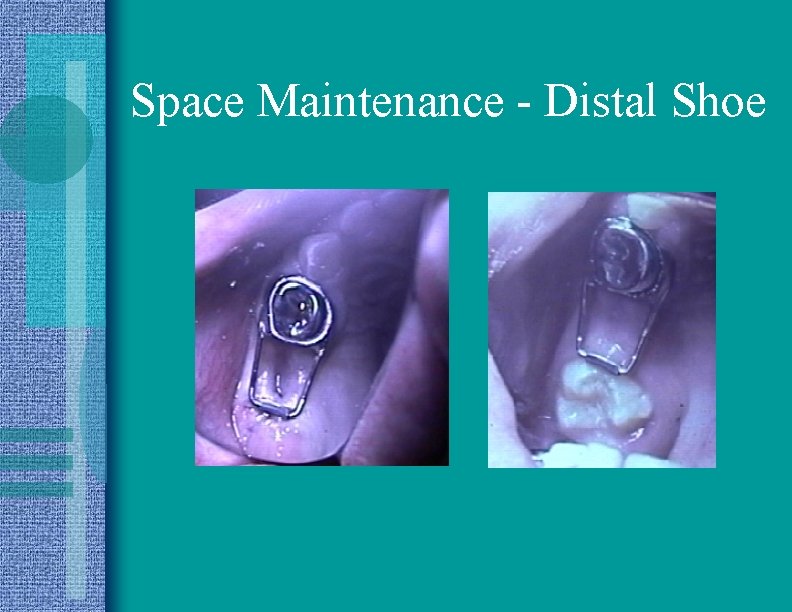 Space Maintenance - Distal Shoe 