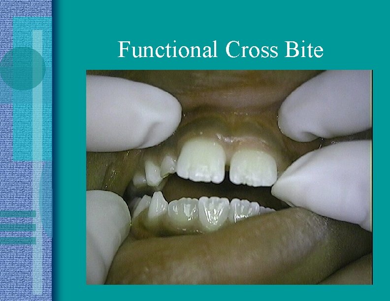 Functional Cross Bite 