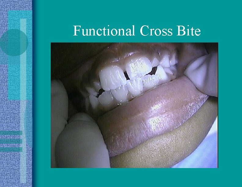 Functional Cross Bite 