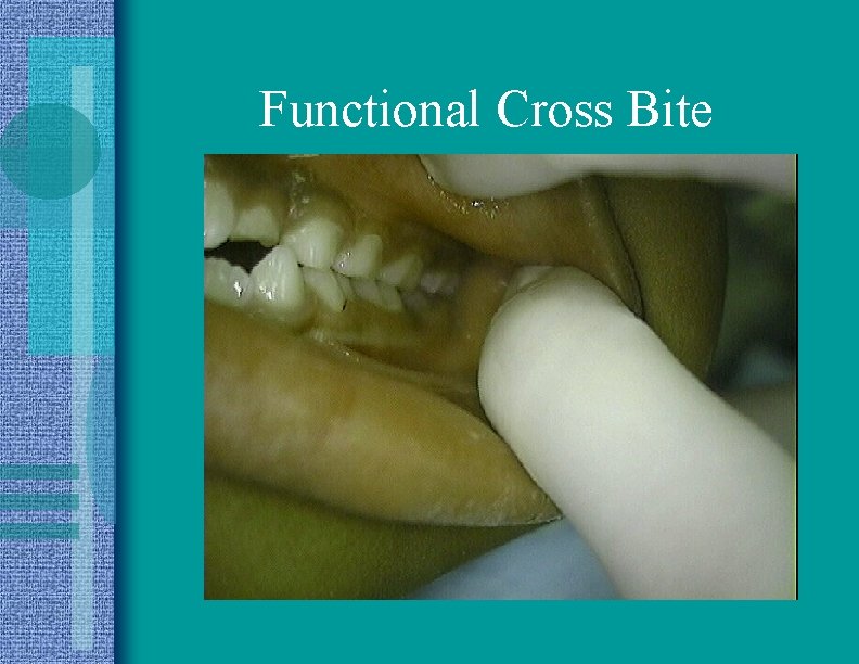 Functional Cross Bite 