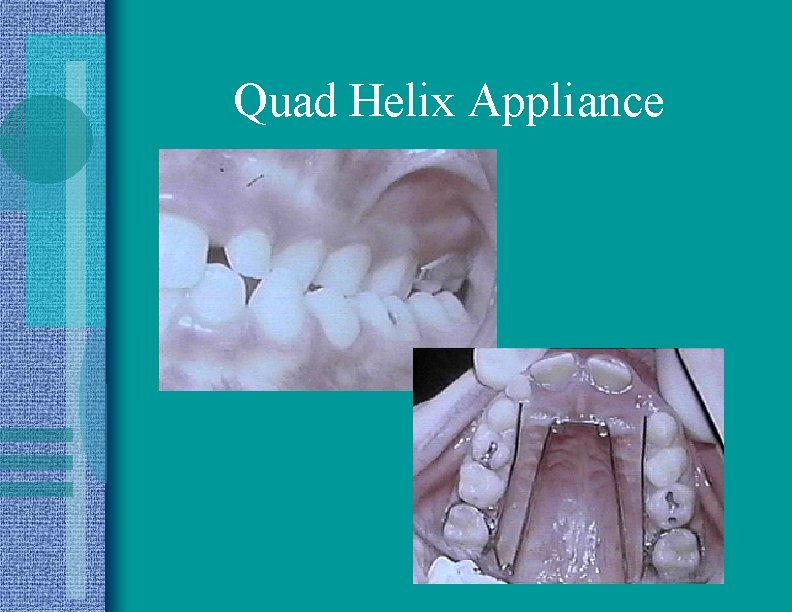 Quad Helix Appliance 