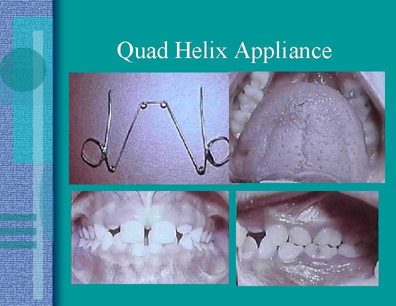 Quad Helix Appliance 