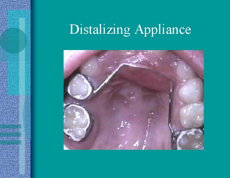 Distalizing Appliance 