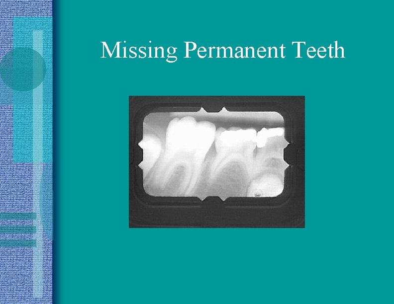 Missing Permanent Teeth 