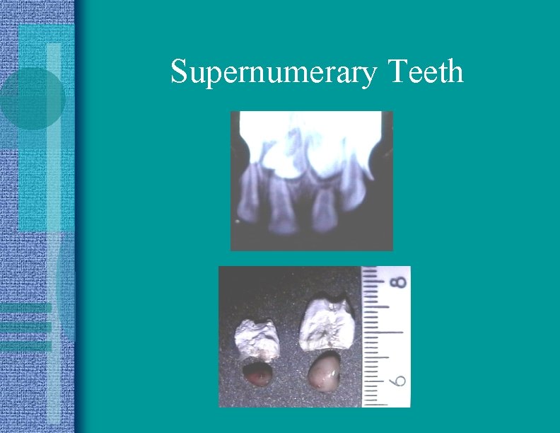 Supernumerary Teeth 