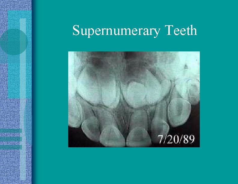 Supernumerary Teeth 