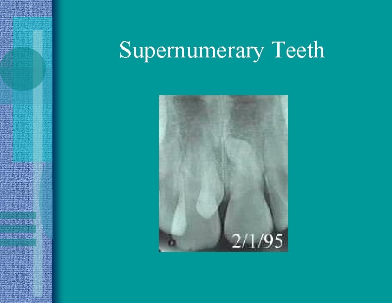 Supernumerary Teeth 