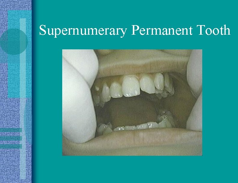 Supernumerary Permanent Tooth 