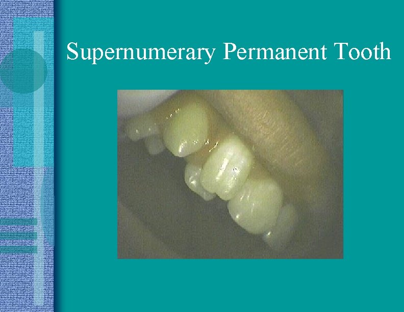 Supernumerary Permanent Tooth 